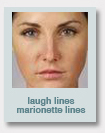 marionette lines