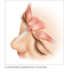 Botox Cosmetic