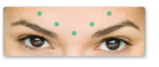 BOTOX® Cosmetic