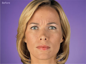 BOTOX® Cosmetic