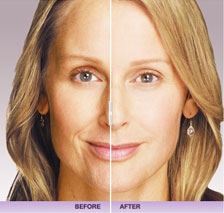 Filler - Juvederm®, Radiesse®, Restylane®
