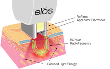 skin-tightening